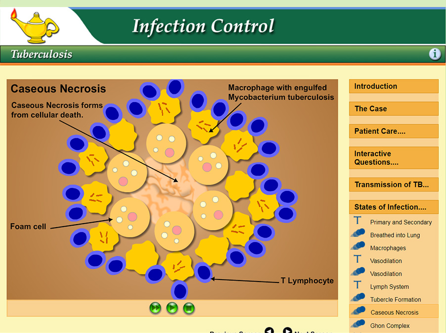 Illustration of caseous necrosis inside of a tubercle surrounding Mycobacterium tuberculosis